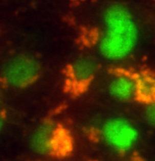 Brain Tumor Stem Cells