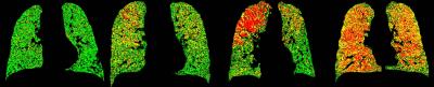 COPD Severity Seen via PRM Analysis of Lung CT Scans