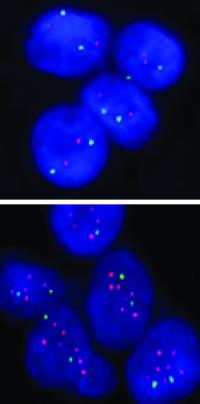 Breast Cancer Cells