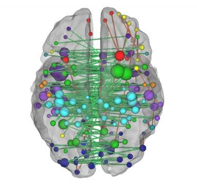 Functional MRI Scans Provide Crucial Data for Stroke Patients