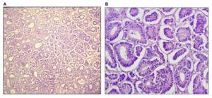 A rare case: Pure Sertoli cell tumor uncovered in atrophic ovary during postmenopausal vault prolapse evaluation
