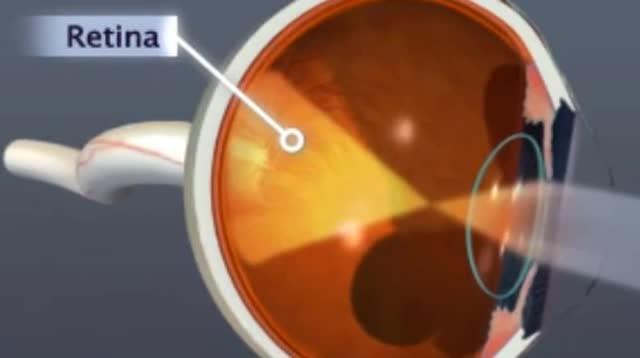 Lucentis Effective for Proliferative Diabetic Retinopathy