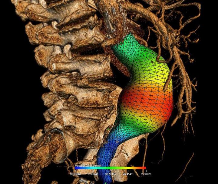 Treating Aortic Aneurysms through Virtual Reality