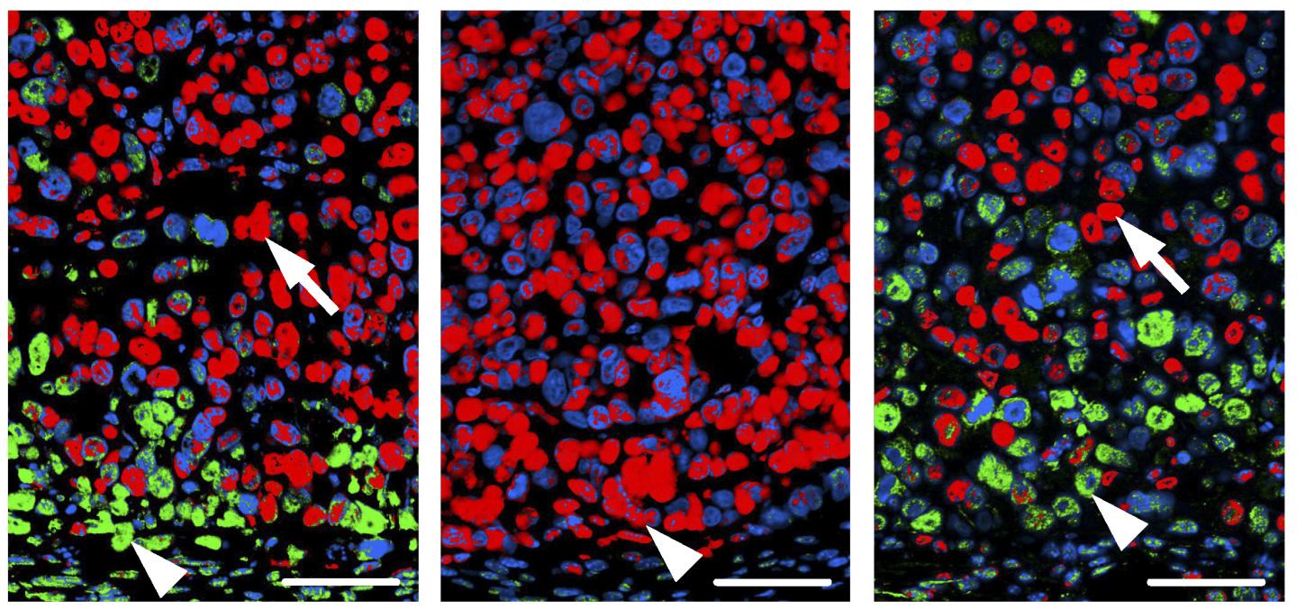 Treatment with MAPK Inhibitor Only Kills Some Colon Cancer Cells in Mice
