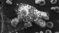 Modified Vitamin D Shows Promise as Treatment for Pancreatic Cancer