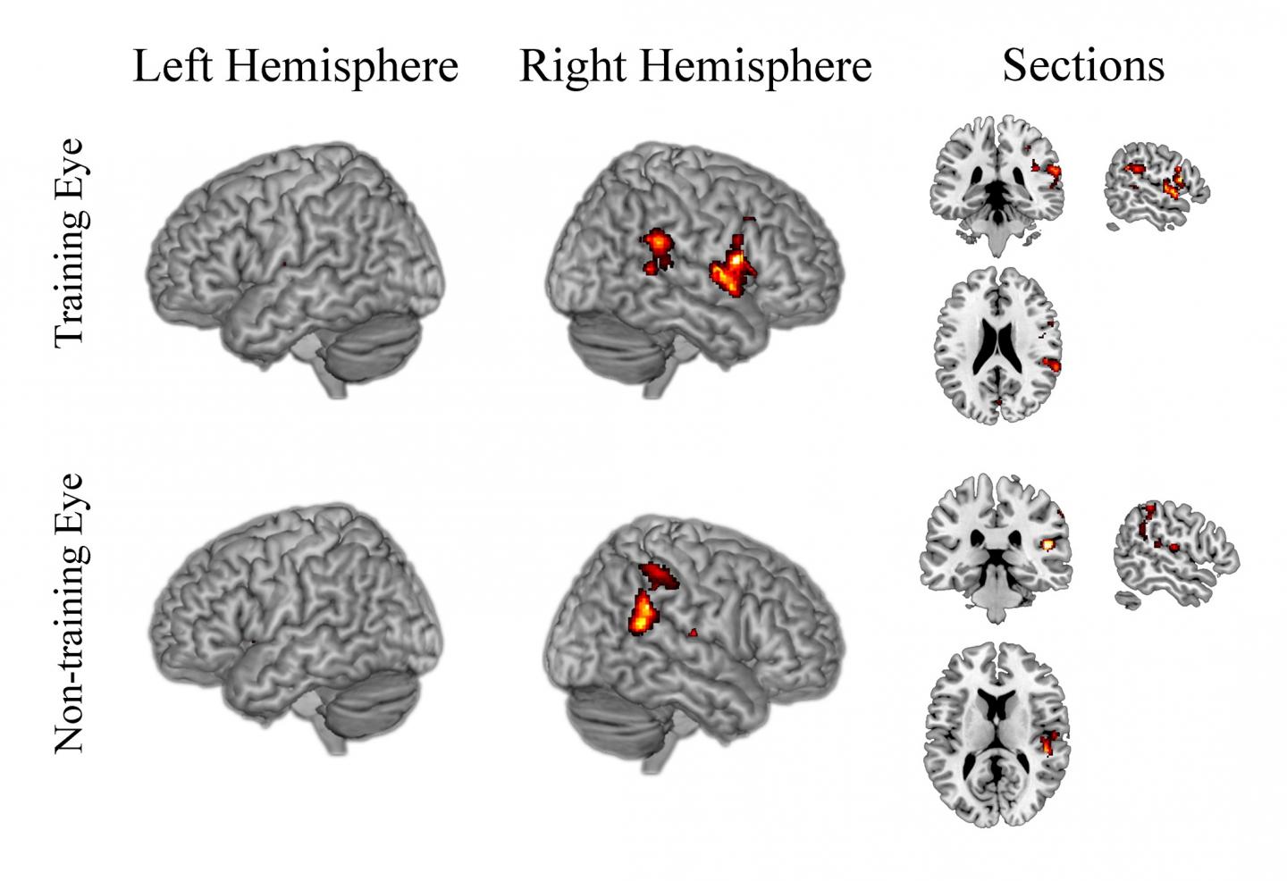 Attention Network Plays Key Role in Restoring Vision After Brain Damage
