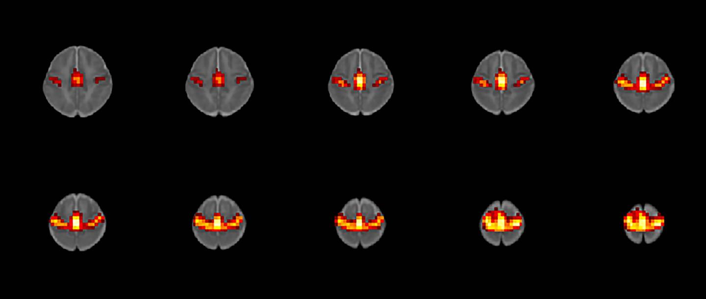Prenatal Opioid Exposure May Alter Brain Function in Babies