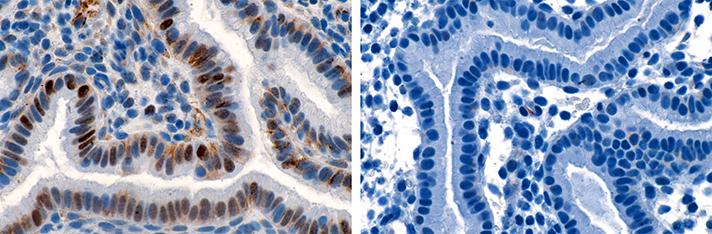 Progesterone May Be Key to Preventing Recurrent Early Miscarriage
