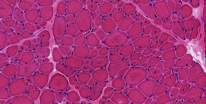 Diseased Muscle Tissue Gene Therapy Study