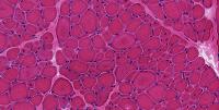 Diseased Muscle Tissue Gene Therapy Study