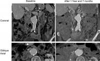 Presence of Blood Clot Associated with Rapid Aortic Aneurysm Growth (2 of 3)