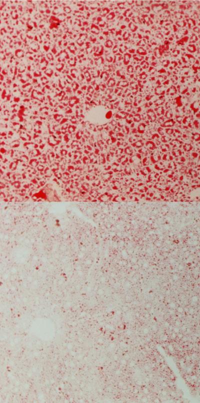 Nonalcoholic Fatty Liver Disease