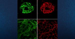 Breast Cancer Cells