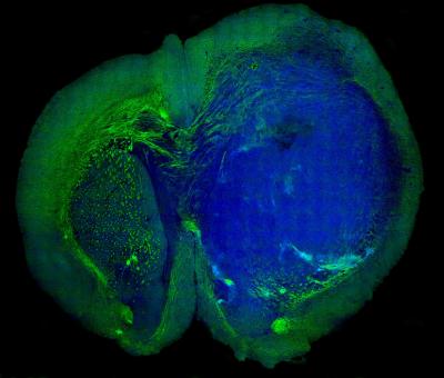 Human Glioblastoma Brain Tumor