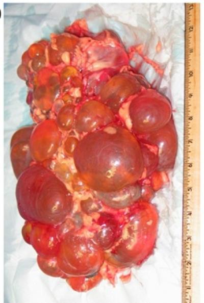 Diseases of Kidney