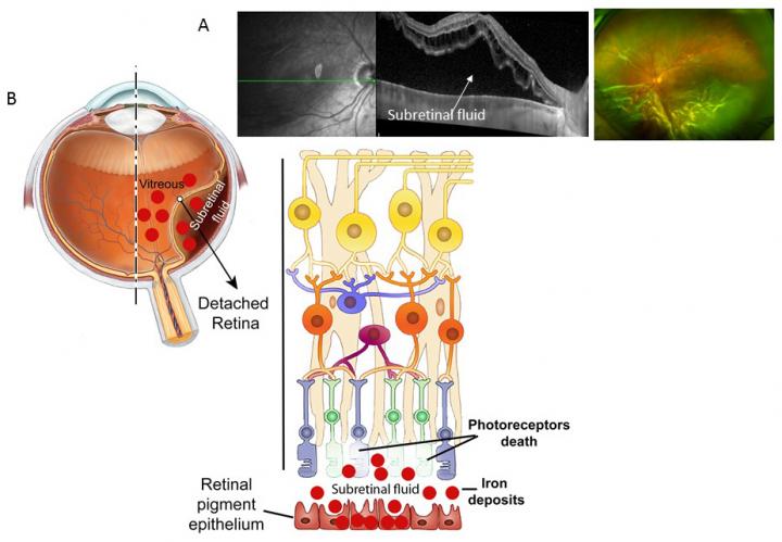 The Link Between Iron and Vision Loss, and a Potential Therapeutic Agent (1 of 1)