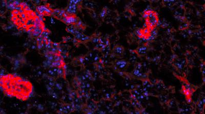 Rheumatoid Arthritis