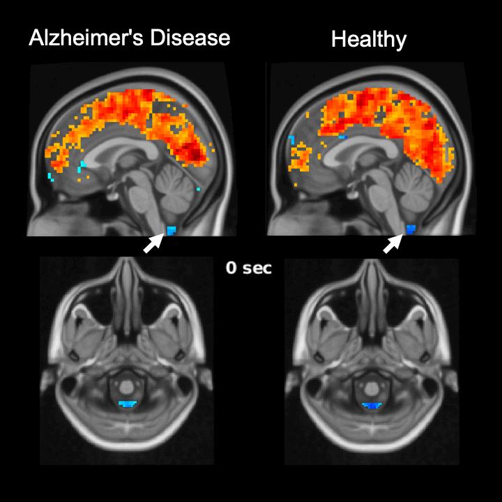 Role of sleep-related brain activity in clearing toxic proteins and preventing Alzheimer's disease