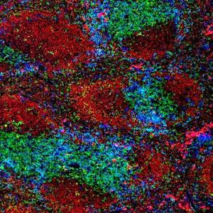 Pulmonary infection patterns in immunocompromised ICU patients