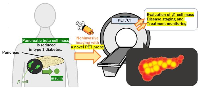 Bringing diabetes treatment into focus