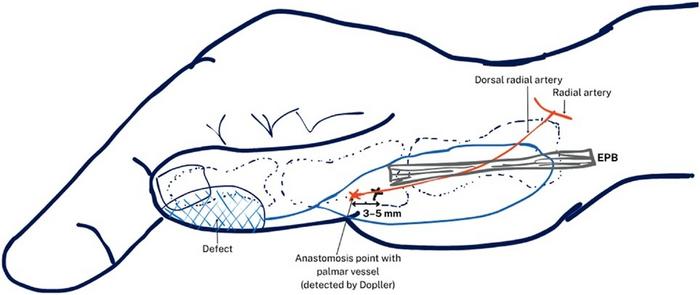 Illustration showing the relationship between the Doppler-identified arterial signal and the anticipated pivot point during flap disection.