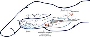 Illustration showing the relationship between the Doppler-identified arterial signal and the anticipated pivot point during flap disection.