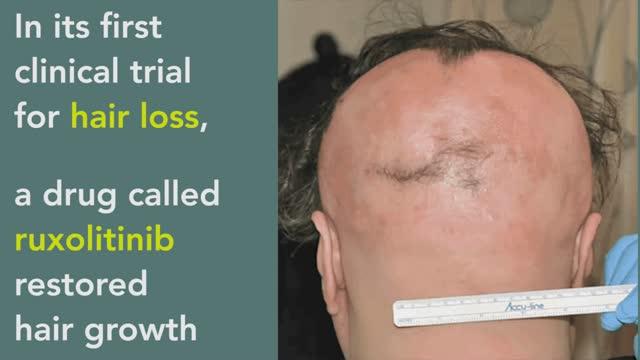 Drug Restores Hair Growth in Patients with Alopecia Areata