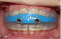 Myobrace Front
