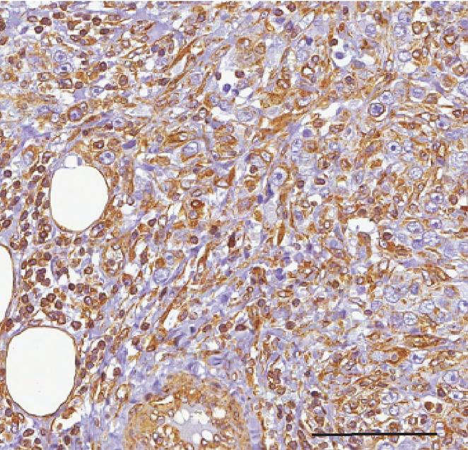 Tumor sample from a breast cancer patient expressing high levels of the microRNAs miR-146a and miR-146b.