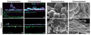 Patient-specific EAC treated on-a-chip