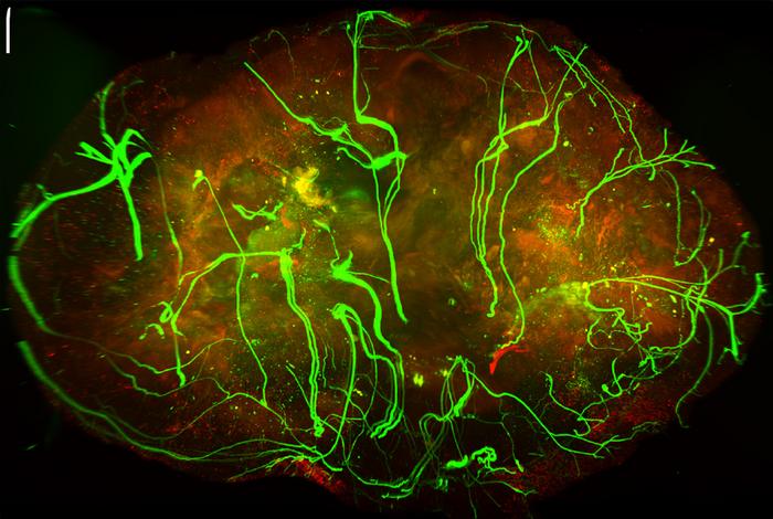 Nerves in Skin Can Slow Melanoma Growth