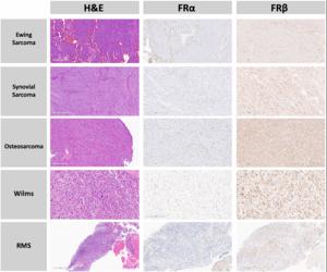 Widespread folate receptor expression in pediatric and adolescent solid tumors - opportunity for intraoperative visualization with the novel fluorescent agent pafolacianine