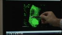 ALS Motor Neuron Imaging Showing Abnormal Protein