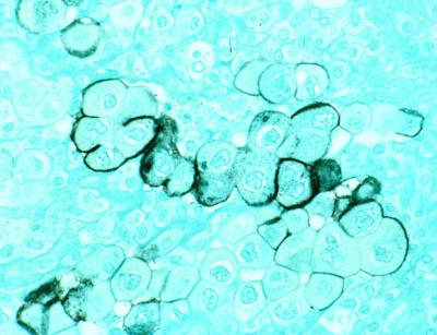 Pancreatic Cancer