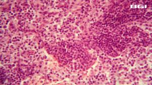 Novel Study Reveals Three New Subtypes Guides Precision Follicular Lymphoma Treatment