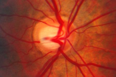 Optic Nerve