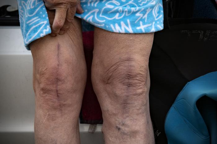 Knee Replacement Scars
