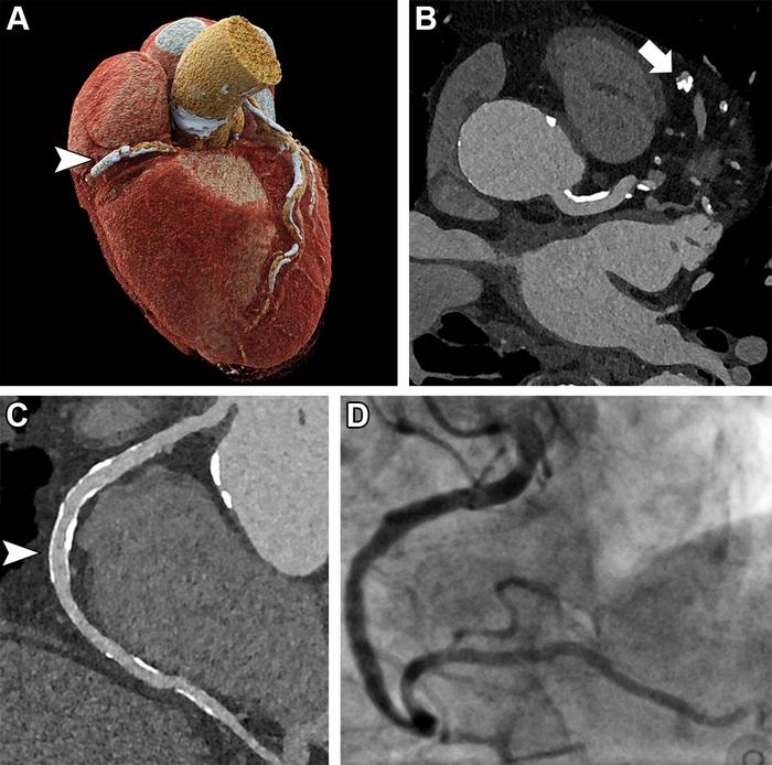 Coronary intravascular brachytherapy for in-stent restenosis