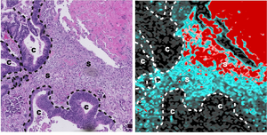 Oxaliplatin accumulation