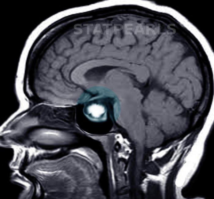 A multidisciplinary roadmap for better prolactinoma care