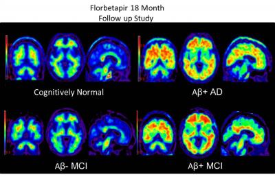 PET Images of Brain Tissue