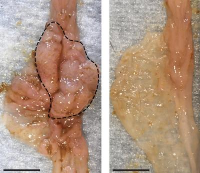Intestinal Tumors