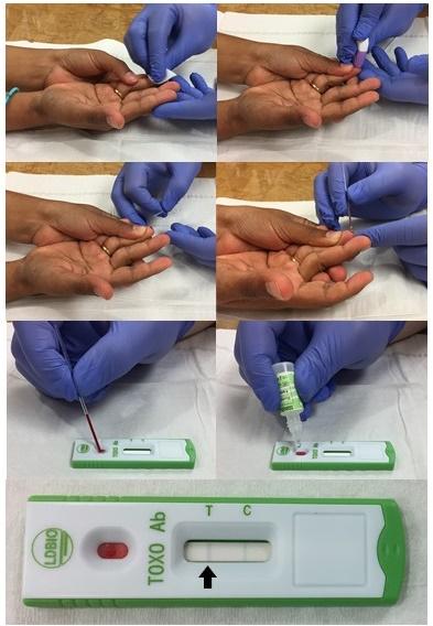 Whole Blood Test for Toxoplasmosis Is Sensitive, Specific