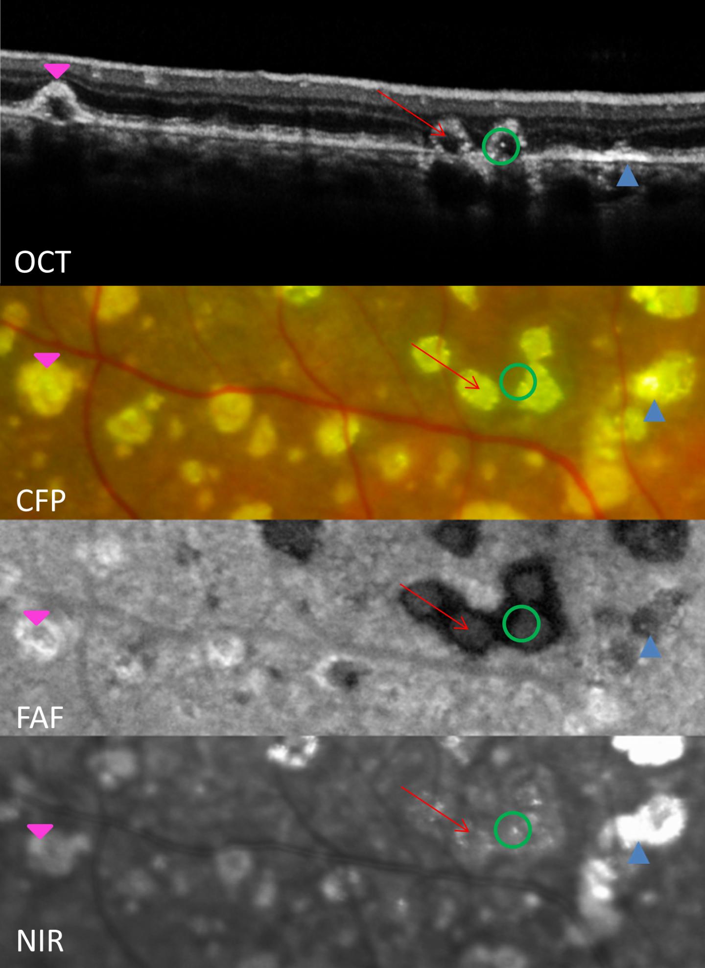 Calcified Eye Spots Linked to Progression of Common Vision Disorder (1 of 2)