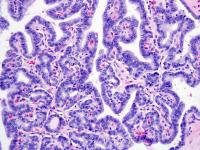 Thyroid Cancer (2 of 3)