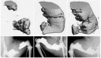 Bone Repair with Stem Cell Seeded Scaffold