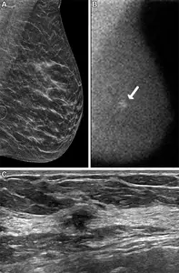 Images in a 62-year-old woman who presented for screening.