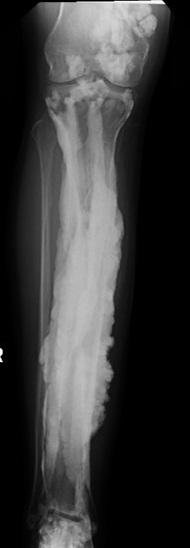 Melorheostosis of the Leg