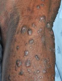 Prurigo Nodularis