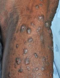 Racial differences uncovered in debilitating itchy skin